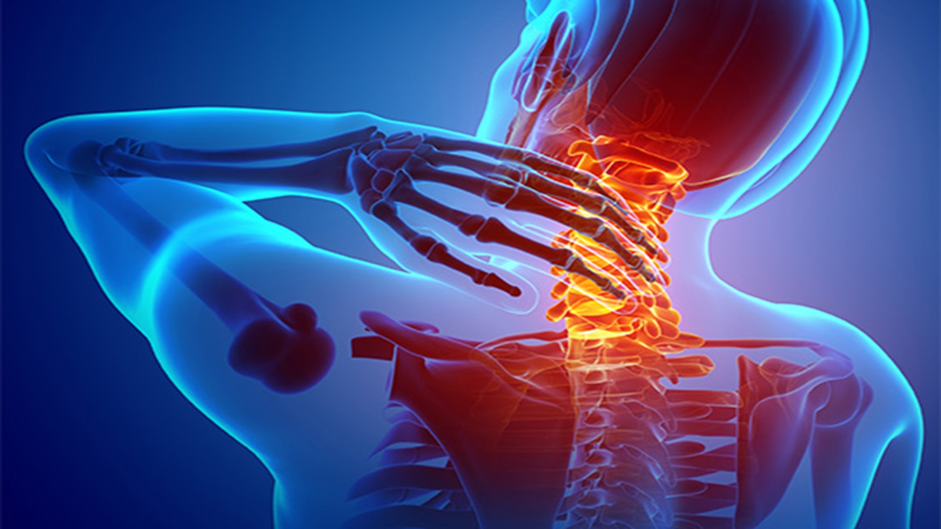 Nyeri Leher Menjalar ke Tangan? Kenali Cervical Radiculopathy dan Cara Mengatasinya