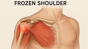 Bisakah Frozen Shoulder Dipijat? Ini yang Perlu Kamu Tahu